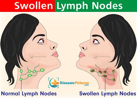 What does a swollen lymph node in cheek feel like?