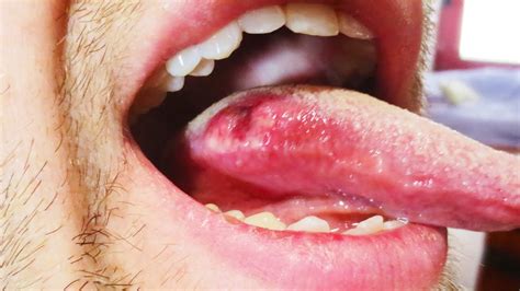 What does a tongue infection look like?