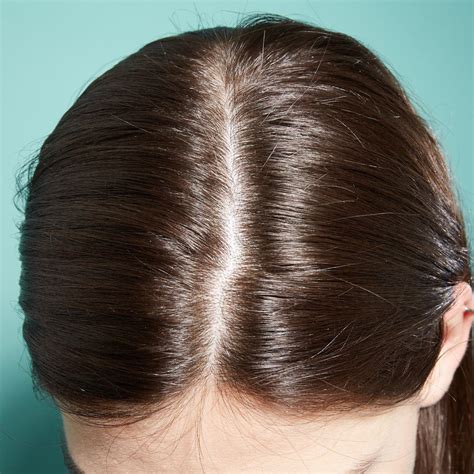 What does a unhealthy scalp look like?