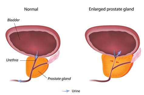 What does a weak prostate feel like?