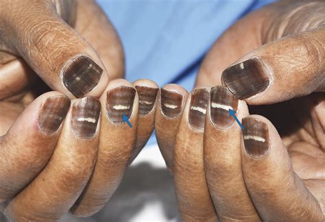 What does alcohol do to nails?