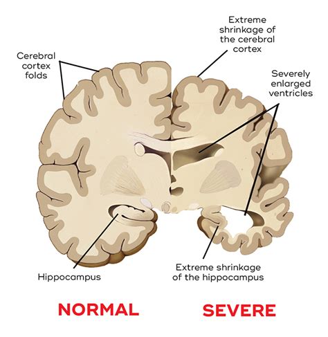 What does aluminum in the brain cause?