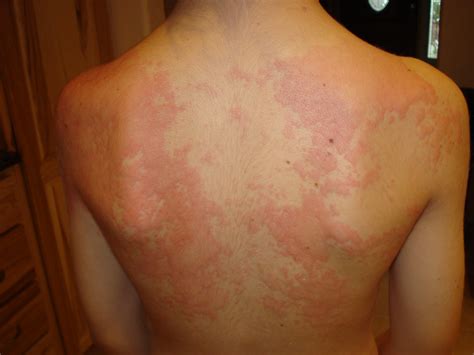 What does an allergy rash look like?