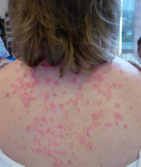 What does an autoimmune rash look like?