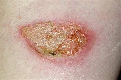 What does an infected burn look like?