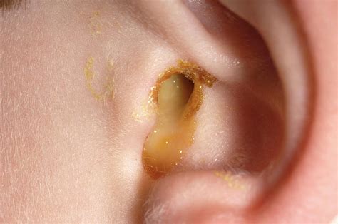 What does an infected ear look like?