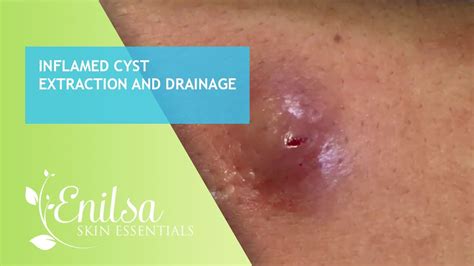 What does an inflamed cyst look like?