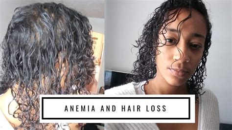 What does anemia hair loss look like?