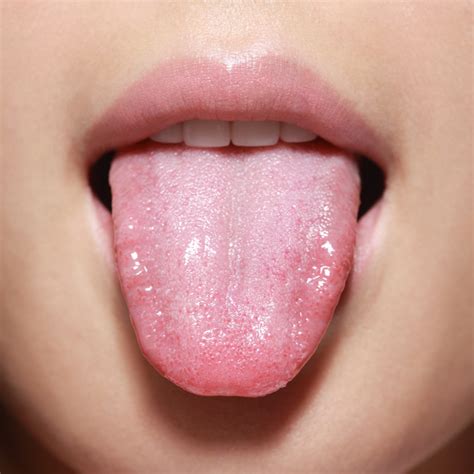 What does anxiety tongue look like?