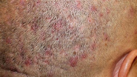 What does bad folliculitis look like?
