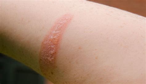 What does burned skin look like when its healing?