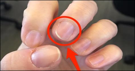 What does calcium deficiency nails look like?