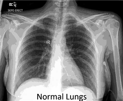 What does clear lungs look like?