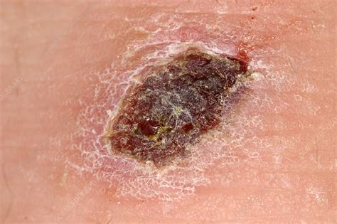 What does dead skin look like on a wound?