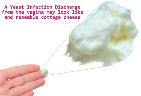 What does discharge look like for yeast infection?