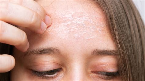 What does dry skin look like?
