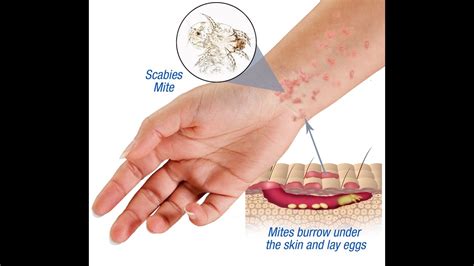 What does early scabies feel like?