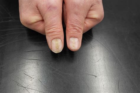 What does fingernail trauma look like?