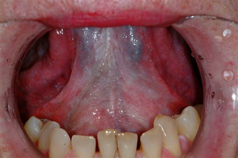 What does floor of the mouth cancer look like?