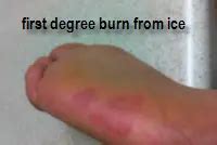 What does ice burn look like?