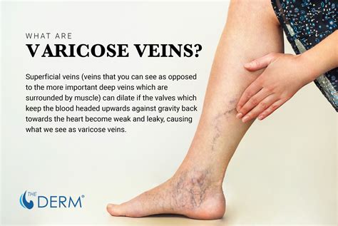 What does it mean if you have good veins?