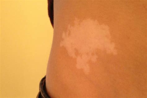 What does it mean to have a white birthmark?