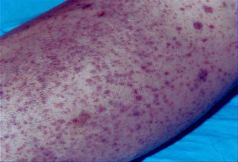 What does leukemia spots look like?
