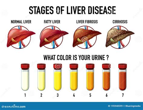 What does liver failure pee look like?