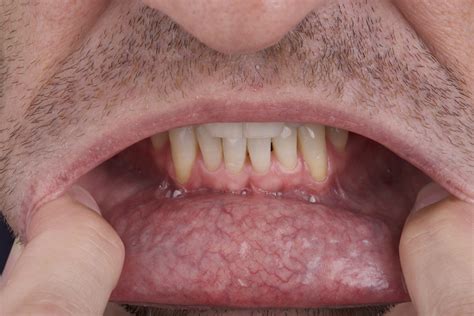 What does oral cancer look like on lips?