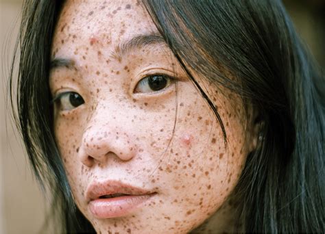 What does period acne look like?