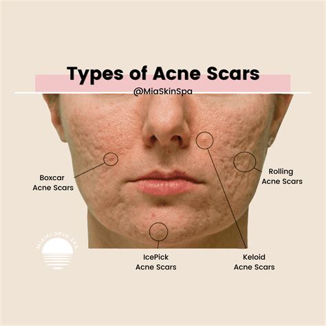 What does permanent pimple scars look like?