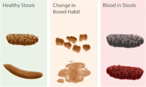 What does poop look like with colon problems?