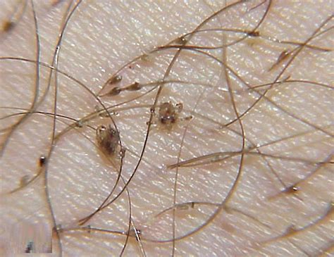 What does pubic lice look like?