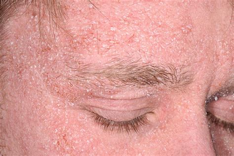 What does seborrheic dermatitis look like on face?
