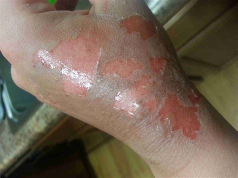 What does second-degree burn look like?