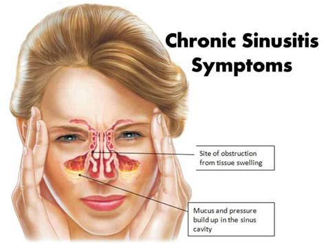 What does sinusitis smell like?