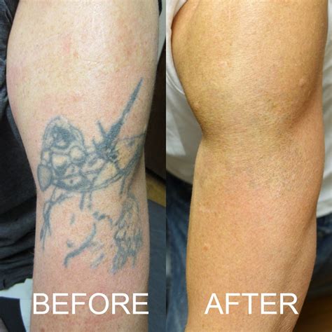 What does skin look like after tattoo removal?