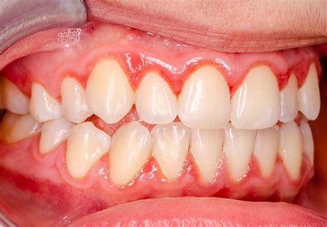 What does stage 1 gingivitis look like?