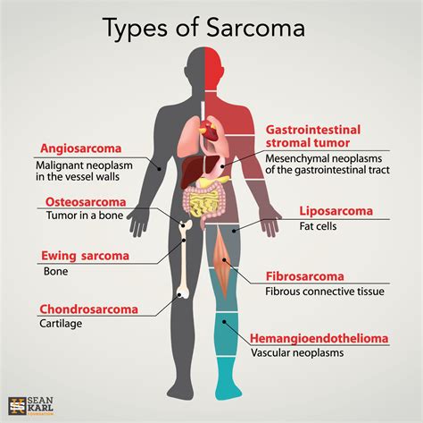 What does stage 1 sarcoma look like?