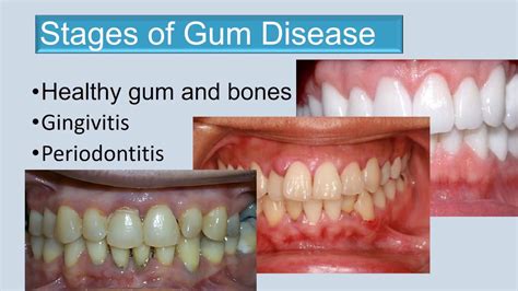 What does stage 3 gum disease look like?