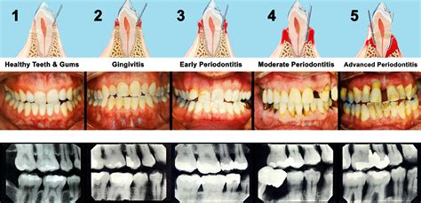 What does stage 4 gum disease look like?
