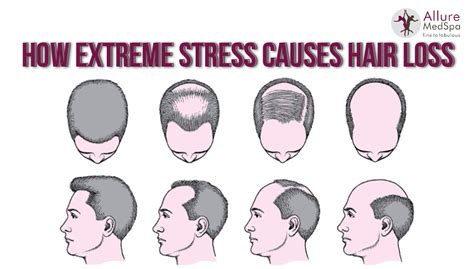 What does stress hair loss look like?