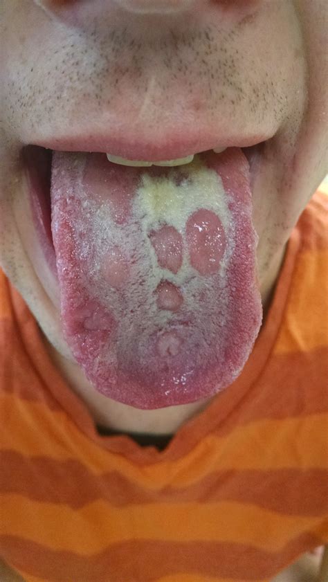 What does syphilis look like?