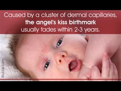 What does the angel kiss birthmark mean?