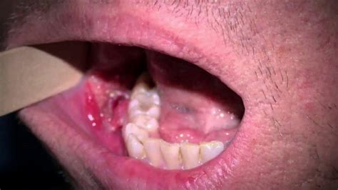 What does the start of mouth cancer look like?