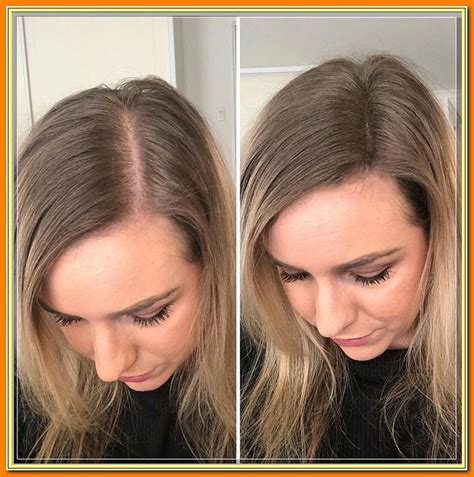 What does thinning hair look like female?