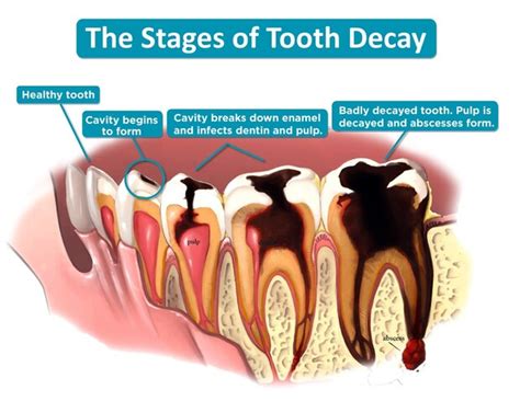 What does tooth decay taste like?