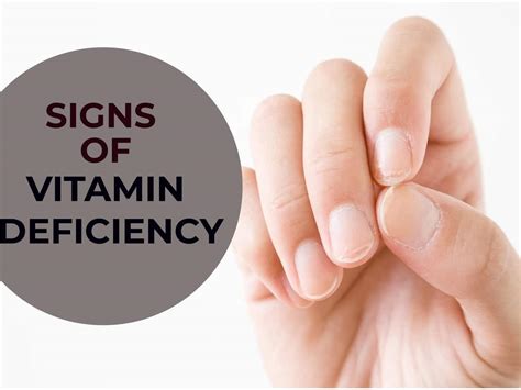 What does vitamin D deficiency look like in nails?