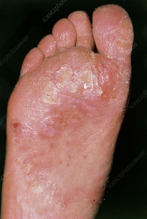 What does yeast on feet look like?