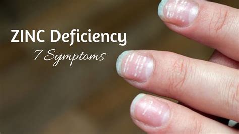 What does zinc deficiency look like in your fingernails?